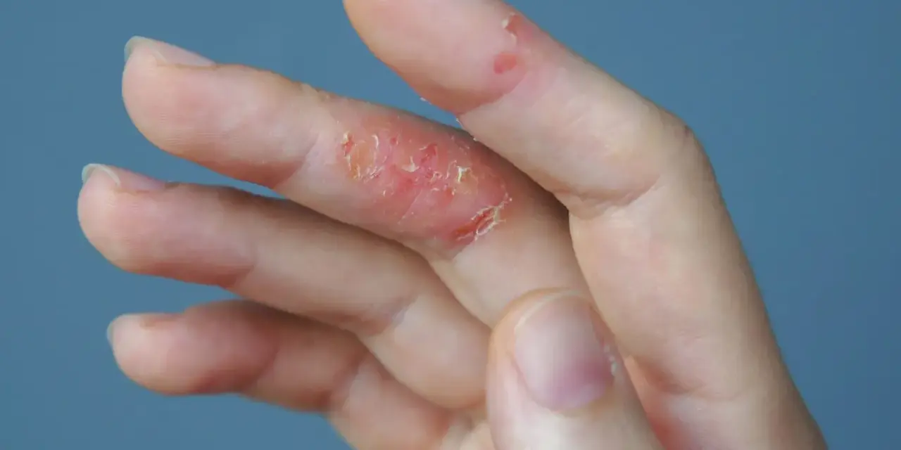 Dedos con piel irritada y escamosa, indicando un fuerte picor en las manos.