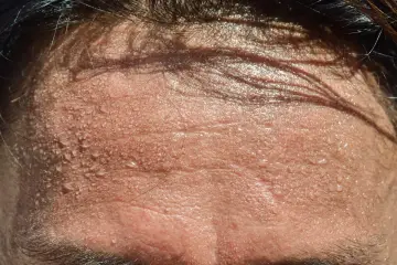 Frente sudorosa con gotas de agua. ¿Buscas trucos para no sudar por la cabeza?