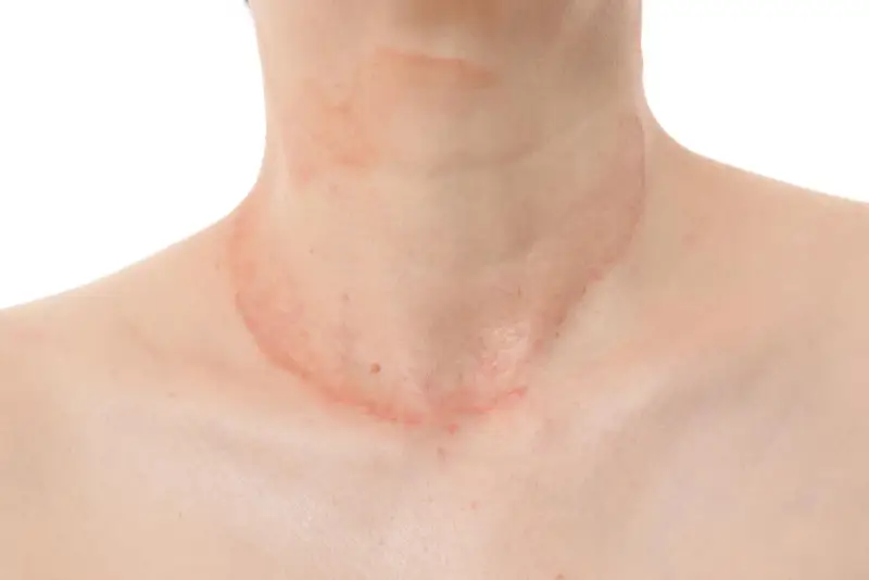 Piel con erupción rojiza y escamosa en el cuello, sugiriendo la presencia de hongos en el cuello.