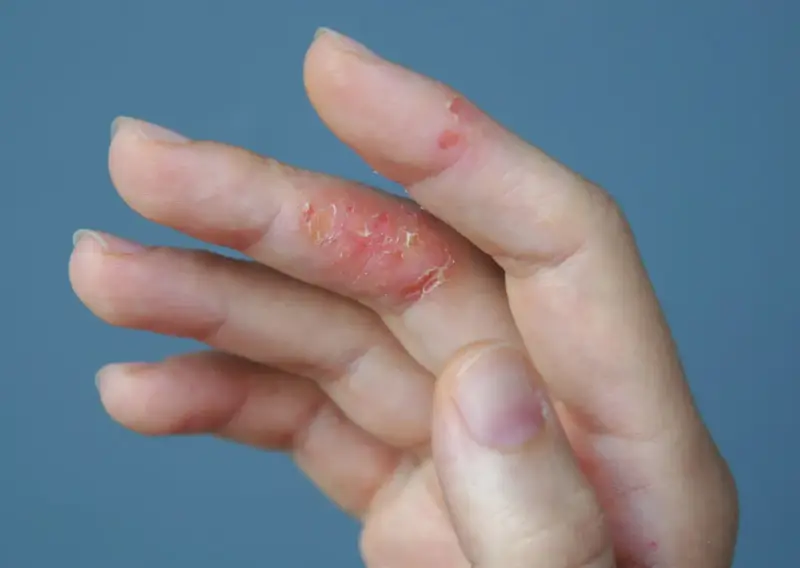 Dedos con piel irritada y escamosa, indicando un fuerte picor en las manos.