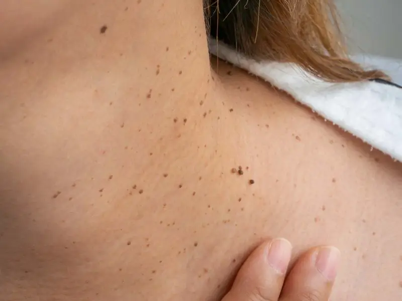 Primer plano de la piel del cuello con numerosas verrugas y lunares. Una mano toca suavemente la piel.